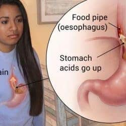 acid reflux